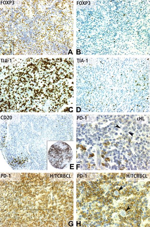 Figure 4. Immunohistochemical patterns of CD20, FOXP3 TIA-1, and PD-1 expression. (A) FOXP3 nuclear positivity in numerous reactive lymphocytes (IHC score 3), but not in Reed-Sternberg cells (inset) in a cHL case with favorable outcome. In contrast, only rare scattered FOXP3-positive lymphocytes (IHC score 1) are observed in a cHL case with unfavorable outcome (B). TIA-1 positivity in cHL cases with poor outcome was frequently observed as high (IHC score 3) (C), whereas cHL cases with favorable outcome often display a low level (IHC score 1) of TIA-1 expression (D). (E) CD20 reactivity on a TMA core from a case of cHL with unfavorable outcome, which contained only scarce positive reactive lymphocytes (IHC score 1), compared with the strong CD20 positivity (IHC score 3) of a case of cHL with favorable outcome (inset). PD-1 immunostaining was detected in a minority of reactive lymphocytes in most cHL cases (F), whereas Reed-Sternberg cells are negative (F, ). As expected from cDNA microarray data, the PD-1 antibody strongly stained the vast majority of reactive T lymphocytes in H/TCRBCL cases (G), whereas neoplastic B cells were negative, as evidenced by high-power view (H, ). Panels A-D and G were obtained using a 20×/0.6 objective lens (×200 magnification). Panel E was obtained using a 10×/0.32 objective lens (×100 magnification). Panels F and H correspond to a 40×/0.75 lens (×400 magnification).