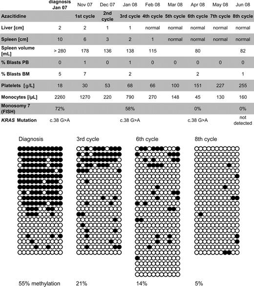 Figure 1. Summary of clinical course and methylation studies. The top panel shows clinical response parameters as liver and spleen size (in centimeters below costal margin), blast percentage, platelet count, monocyte count, and cytogenetic studies of bone marrow cells. Diagrams in the bottom panel depict the CALCA gene methylation status in bone marrow cells at diagnosis, before the third cycle and eighth cycle of azacitidine. The methylation of 11 CpG dinucleotides located between +172 bp and +325 bp relative to the CALCA transcription start site was mapped by sequencing multiple cloned alleles obtained from PCR on bisulfite-treated genomic DNA. Each horizontal line represents an individual allele (20-24 per sample). ● represents methylated CpG sites; ○, unmethylated CpG sites. FISH indicates fluorescence in situ hybridization.