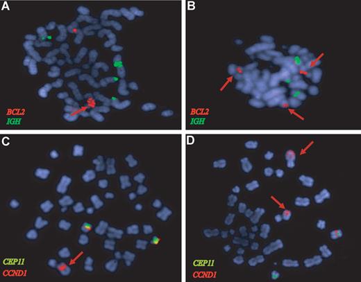 Figure 3. BCL2 and CCND1 gene amplifications in MCL confirmed by FISH analysis. FISH of representative metaphases with BCL2 (red), IGH (green), CCND1 (orange), and CEP11 (green) specific probes. (A) The HBL2 cell line shows a tandem high-copy number BCL2 amplification (red arrow). (B) The BCL2 locus is amplified in a primary MCL (red signals) from the validation set that also showed a 18q21 amplification by CGH. (C) The HBL2 cell line has an amplified CCND1-IGH rearrangement (red arrow) and 2 nontranslocated chromosomes 11 with CCND1 signal (red) below the centromere of chromosome 11 (green). The CCND1-IGH amplified fusion was confirmed by a dual-color dual-fusion probe (data not shown). (D) The MAVER1 cell line has 2 high-level tandem amplifications of CCND1 (red arrows) in 2 different chromosomes: one corresponds to the complex t(11;14) translocation in chromosome 6.11 The chromosome carrying the second amplified region has not been identified. A nontranslocated chromosome 11 with the red CCND1 signal associated with the green centromere 11 probe is also observed.