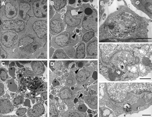 Figure 6. RAD001 promotes autophagy and induces apoptosis. Ultrastructural analysis by TEM of ultrathin BM sections in mice treated with vehicle (A), vincristine (B), RAD001 (C), and vincristine plus RAD001 (D). Apoptotic cells (), extravasated erythrocytes (*), filipodia (white arrows), and phagolysosomes (white arrowheads) are indicated. Double-walled polyphagic vacuoles in the cytoplasm of ALL cells from ALL-1345 (E) and ALL-1999 (F,G) recovered from mice treated with RAD001. Bars represent 1 μm. See “Electron microscopy” for details. Larger images are available in Figure S4.