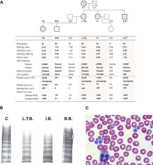 Figure 1. Characteristics of the Montreal platelet syndrome kindred. (A) Genogram and laboratory data with affected family members indicated by shading and previously studied subjects by bold text and bold genogram symbol outline. In the hemostatic variables, HMW indicates high molecular weight; N/D, not determined; □, subject lost to follow-up; therefore, permission was not obtained to print identifying information. *Normal range, 7 to 11 fL; †Normal, < 9.5 minutes; ‡normal range, 84 to 176 seconds; §normal range, 63 to 111 seconds. (B) Sodium dodecyl sulfate–agarose gel electrophoresis of plasma VWF multimers showing loss of HMW VWF multimers in representative subjects affected with MPS (L.T.B., I.B.) and normal plasma HMW VWF multimers in a representative unaffected family member (B.B.) and a control (C). (C) Peripheral blood film showing large platelets and platelet clumping.