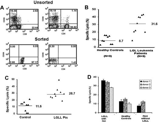 Figure 1. CD8+ T cells from LGLL patients display enhanced lysis of a normal pulmonary artery endothelial cell line. (A) Percentage of CD56+, CD8+, and CD4+ T cells by flow cytometric analysis in unsorted and sorted populations after negative selection using RosetteSep. (B) CD8+ T cells were purified from LGLL patients and healthy blood donors. Direct cytotoxicity was performed using 5-hour 51Cr release assays. CD8+ T cells were incubated with 51Cr-labeled CRL-2598 endothelial cells at an E/T ratio of 50:1, and the CD8+ T-cell–mediated cytolysis of CRL-2598 cells was compared among LGLL patients (n = 9) and healthy controls (n = 9). (C) CD8+ T cells from LGLL patients are cytotoxic toward synovial cells. CD8+ T cells were purified from LGLL patients and healthy blood donors. Direct cytotoxicity assays were performed using 5-hour 51Cr release assays. CD8+ T cells were incubated with 51Cr-labeled HTB293 synovial cells at an E/T ratio of 50:1. CD8+ T-cell–mediated cytolysis of HTB293 cells was compared among 9 LGLL patients and 9 healthy controls. (D) CD8+ T cell–mediated cytolysis of CRL-2598 cells was compared among patients presenting with LGLL and PAH (n = 3), PAH without LGLL (n = 2), and healthy controls (n = 3). The mean and SEM of triplicate wells are shown.