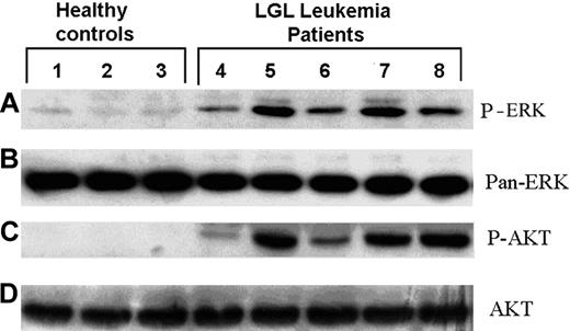 Figure 3. CD8+ T cells from LGLL patients maintain constitutively activated ERK1/2 and PI3K. CD8+ T-cell lysates were prepared from LGLL patients and healthy donors. The activity of ERK and PI3K in these cells was assessed by Western blot analyses using antibodies specific for (A) phosphorylated ERK1/2 (pERK) and (C) phosphorylated AKT. Membranes were stripped and reprobed with antibodies that detect (B) pan-ERK and (D) pan-AKT to demonstrate total protein levels.
