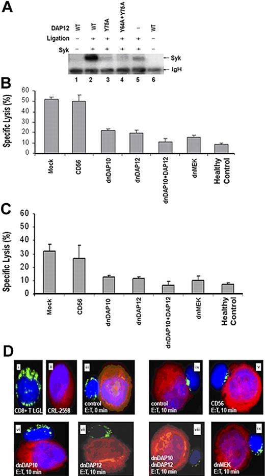 Figure 6. Expression of dnDAP12 and/or dnDAP10 in CD8+ T cells from LGLL patients reduces adaptor signaling, cytotoxicity toward CRL-2598 cells, and granule redistribution. (A) Expression of dnDAP12 blocks Syk phosphorylation. AD293 cells were cotransfected with plasmids encoding Syk and 1 of the following FLAG-tagged DAP12 constructs: wild type (WT, lanes 2), DAP12Y75A (lane 3), or DAP12Y64A;Y75A (lane 4). Single transfections with Syk and WT DAP12 are included as negative controls (lanes 1, 5, and 6). After cross-linking with anti-Flag antibody, DAP12 was immunoprecipitated before Western blot analyses with an antiphosphotyrosine antibody (4G10). The blot was subsequently stripped and reprobed with an anti-Syk antibody confirming that the phosphorylated protein is Syk (data not shown). (B) Expression of dnDAP10 and dnDAP12 reduce the cytotoxic potential of CD8+ T cells from LGLL patients. The cytotoxic properties of genetically modified CD8+ T cells from LGLL patients were evaluated in 5-hour 51Cr release assays. CD8+ cells were infected with recombinant vaccinia virus encoding CD56 (negative control), dnDAP10, dnDAP12, or a combination of dnDAP10 and dnDAP12(Y75A), as well as dnMEK (positive control) and mixed at an E/T ratio of 50:1 with CRL-2598 target cells. Mock-infected CD8+ T cells from LGLL patients and healthy controls are included for comparison. Representative results from 1 LGLL patient are shown: cells from 5 other patients yielded similar results. The inhibitory effects of dnDAP10 and dnDAP12 occurred at E/T cell ratios ranging from 50:1 to 6:1 (data not shown). The mean and SEM of triplicate wells are shown. (C) Expression of dnDAP12 and/or dnDAP10 in CD8+ T cells from LGLL patients reduces cytotoxicity toward synovial cells (HTB293). Direct cytotoxicity was performed using 5-hour 51Cr release assays as described in Figure 7B. Results from 1 representative patient and healthy control are shown: similar results were obtained from 5 additional patients. The mean and SEM of triplicate wells are shown. (D) Target cell–induced granule redistribution is blocked in CD8+ T LGLL expressing dnDAP10 and/or dnDAP12. A proportion of the cells described in panel B were mixed at 1:1 E/T ratio and examined for granule redistribution. Cells were cytospun onto slides and lytic granules visualized with (i) a FITC-conjugated anti–granzyme B antibody (green). (ii) CRL-2598 target cells were prestained with Cell-Tracker Orange (red: Molecular Probes). DAPI was used for nuclear staining (blue) of both cell types. Results using untreated CD8+ T LGLL cells are shown at (iii) 0 and (iv) 10 minutes after mixing. Representative results using CD8+ T LGLL cells expressing (v) CD56 (negative control), (vi) dnDAP10, (vii) dnDAP12(Y75A), (viii) dnDAP10, and dnDAP12(Y75A) and (ix) dnMEK are shown. Results from 1 representative experiment are shown: results from 4 other patients yielded similar results (data not shown).