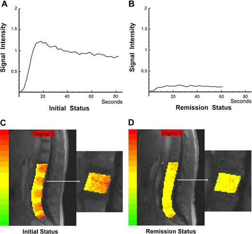 Figure 1. The time-intensity curves derived from DCE-MRI and color-coded angiogenesis maps of vertebral bone marrow in a 54-year-old female patient with de novo AML are shown. She achieved complete remission after induction chemotherapy. Her remission duration until the end of August 2007 was 1002 days. The time-intensity curve (A) and color-coded angiogenesis map (C) at initial diagnosis are shown; those in complete remission are shown (B,D), respectively.
