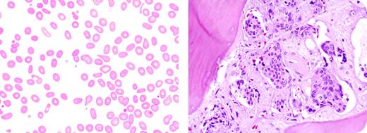 A 46-year-old woman developed mild backache during her usual aerobic exercises. The pain disappeared in several days with an anti-inflammatory drug. She was in her fourth year of follow-up for breast cancer (stage III, ER positive) that was treated with adriamycin and cyclophosphamide followed by tamoxifen. / Several weeks after this episode, she visited her oncologist for routine follow-up. Nothing was found on physical examination. However, after the oncologist reviewed the peripheral smear (see left image) and noted red cell deformities, he questioned the woman again about any problems, at which time she recalled the backache. / Laboratory work revealed mild anemia and an elevation of the alkaline phosphatase. A bone scan showed 3 to 4 areas of activity, including the region of the previous backache. / A bone marrow aspirate and biopsy were performed. A section of the marrow (see right image) illustrates numerous foci of extraneous cells, consistent with metastatic adenocarcinoma. Additional tests affirmed the diagnosis of metastatic breast cancer. Her hormone therapy was changed and new chemotherapy was instituted. / In this case, abnormal red cell morphology of the peripheral smear was the clue to the relapse of malignancy.