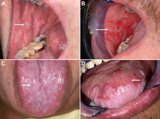 Figure 1. Clinical spectrum of oral GVHD, ranging from mild, predominantly lichenoid lesions to more severe, ulcerative lesions. (A) Lichenoid changes of the buccal mucosa. Note white striations (arrow). (B) Severe cGVHD of the buccal mucosa. Note pronounced erythema and the presence of ulcerations (arrow). (C,D) Mild and severe changes of the tongue.