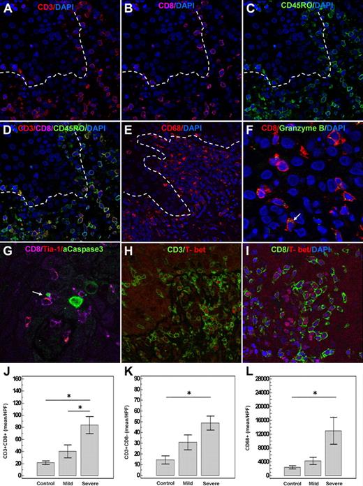 Figure 3. Infiltrating T cells express markers of cytotoxicity, type 1 cytokine polarization, and effector-memory phenotype. (A-D) Infiltrating T cells express CD45RO, a surface marker of the effector-memory T cells. Note predominance of the CD8 cells in the infiltrate. (E) CD68 myeloid cells are also overrepresented in oral cGVHD. CD8 cells express granzyme B (F) and Tia-1 (G) in the cytoplasm and are closely associated with the apoptotic cells (green, G). Note polarization of the cytotoxic granule (red) within the CD8 cell (cyan) in the direction of the apoptotic keratinocyte (green) shown by arrow. (B) Close-up of the same image with the arrows pointing to the granzyme B granules. (H,I) T-bet expression by the infiltrating T cells. (J-L) CD8 (n = 8, n = 16, and n = 12 for control, mild, and severe groups, respectively) and CD68 cells (n = 8, n = 15, and n = 10 for control, mild, and severe groups, respectively) are particularly prominent in severe disease (*P < .05; error bars represent SEM).