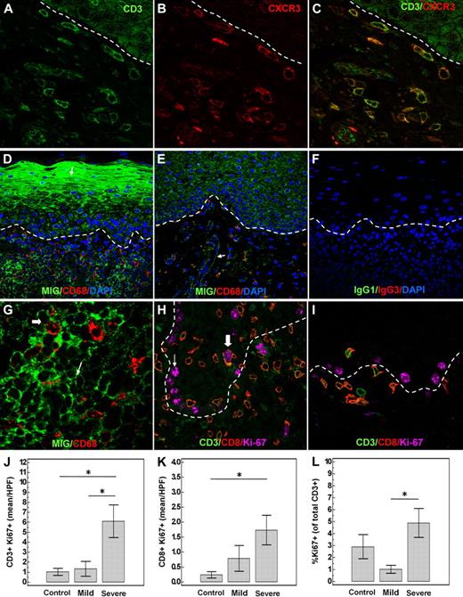 Figure 4. Migration and proliferation of infiltrating T cells in oral cGVHD. Infiltrating T cells (A) express the chemokine receptor CXCR3 (B). (C) Overlay of CD3 and CXCR3. (D) Increased production of the CXCR3 ligand MIG (CXCL9) by the keratinocytes (arrow) and infiltrating cells in a patient with severe oral GVHD. (E) Control patient without oral cGVHD symptoms with minimal MIG expression by the keratinocytes and endothelial cells (arrow). (F) Negative isotype staining control. (G) Enlarged image demonstrating MIG expression by CD68+ cells (large arrow), as well as CD68− cells (small arrow). Infiltrating T cells proliferate in the oral mucosa affected by cGVHD. (H) Severe oral cGVHD; close-up image showing nuclear expression of proliferation marker Ki-67 in a CD8 cell (large arrow). Basal keratinocytes (small arrow) proliferate constitutively. (I) Lack of proliferating T cells in a patient without clinical oral cGVHD. (J-L) Severe cGVHD (n = 12) is characterized by increased number and percentage of proliferating T cells compared with patients with mild (n = 16) or no (n = 8) oral cGVHD (*P < .05; error bars represent SEM).