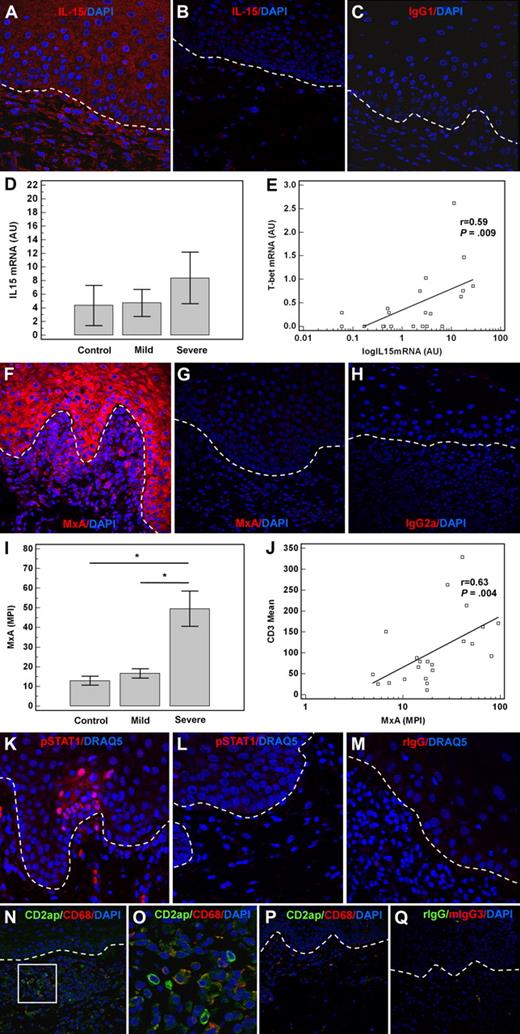 Figure 5. Activation of type I IFN axis in oral cGVHD. (A) IL-15 expression in the keratinocytes and infiltrating cells in a patient with severe oral cGVHD. (B) Patient without oral cGVHD. (C) Negative isotype staining control. IL-15 mRNA (mean ± SEM) is increased in severe oral GVHD (n = 6) compared with mild cGVHD (n = 10) or controls (n = 5) and correlates with that of T-bet (D-E). Increased expression of MxA, IFN α/β–inducible protein, in oral cGVHD. (F) Patient with severe disease. (G) Control patient lacking oral cGVHD. (H) Negative isotype staining control. (I) MxA (MPI ± SEM) is markedly up-regulated in patients with severe oral cGVHD (n = 9) compared with those with mild disease (n = 7) or control patients (n = 6). MxA expression in the affected tissues correlates with the number of infiltrating T cells, assessed as CD3+ cells/HPF (J). STAT1 phosphorylation and nuclear translocation is observed in the patients with severe cGVHD (K), but not control patients (L). (M) Negative isotype staining control. (N) Plasmacytoid dendritic cells identified by expression of CD2ap in the patient with severe oral cGVHD and high type I IFN activity as measured by MxA expression. (O) Close-up of the image in panel N, showing coexpression of CD2ap and CD68 in a granular peripheral pattern. (P) No CD2ap-expressing cells and few CD68 cells are present in the mucosa of a patient without oral cGVHD. (Q) Negative control. AU indicates arbitrary units; MPI, mean pixel intensity.