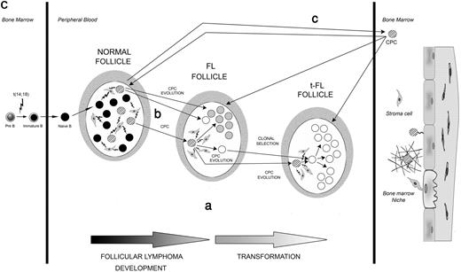 Figure 1. Patterns of evolution of FL and t-FL. (A,B) Two examples of genealogic trees generated by comparison of cloned IgH-VH PCR products and by heteroduplex (HH) analysis, from FL and t-FL samples. The putative CPC sequences were generated by comparison of the common pattern of SHMs observed in the paired FL and t-FL samples. The FL sequences are depicted as , the t-FL clones as ○, and the germline sequence as ·. The putative common progenitor cell and the hypothetical intermediate sequences, which were not detected experimentally, are depicted as . HH corresponds to the sequence identified by HH analysis. Numbers inside the circles correspond to the number of clones with the same sequence, and the numbers beside the arrows represent the additional mutations in the subsequent clone. The roman numbers I, II, III, and so on, on the trees, refer to the intermediate clones. (A) Genealogic trees of patient 1, a case compatible with the existence of a CPC. Genealogic trees generated after comparison of sequences obtained after screening of the FL and t-FL cloned PCR products (i-iii) and after comparison of the homoduplex sequences (iv); (v) graphic timeline representation of the FL/t-FL biopsies investigated and of clinical evolution of disease: vertical arrow represents the line of therapy (either chemotherapy or radiotherapy); left-hand vertical bar, the time of diagnosis; the right-hand vertical bar, time of death; R1, the first relapse; Tr1, the first transformation. (B) Genealogic trees of patient 2, a case compatible with a direct evolution. In this case an additional FL sample (FL2) was investigated. Genealogic tree generated after comparison of the cloned sequences (vi) and of the 2 major clones identified by HH analysis (vii); graphic timeline representation of the sequential biopsies investigated and the clinical evolution of disease: each vertical arrow represents a line of therapy; the bar at the end of the horizontal line, time the death; ww, watch and wait; P, progression; Tr1, first transformation; and R1, first relapse. (C) Models for development and evolution of the CPC cell. The CPC, FL, and t-FL clones are depicted as previously described. Letters a, b, and c represent the 3 patterns of evolution. Pre-B cells acquire the t(14;18) translocation in the bone marrow and then migrate to the GC of the lymph node as a naive B cell. There, because of the interaction with cells of the microenvironment, they undergo the SHM process to give rise to mature B cells. The first hypothesis (i) is that CPC survives the different lines of therapy and coexist with FL and t-FL clones in the GC. The second hypothesis (ii) suggests that the CPC is present only in the GC of the prelymphoma (normal follicle) lymph node and not in the GC of FL or t-FL. The third hypothesis (iii) is that the CPC migrates to the BM (before or after FL) and is maintained in the BM niche before migrating to a secondary lymphoid organ where it evolves into FL or t-FL. The second (ii) and third (iii) evolution pathways both relate to the existence of “premalignant” niches (the first one in the GC and the second one in the BM) where CPC can independently give rise to FL or t-FL.