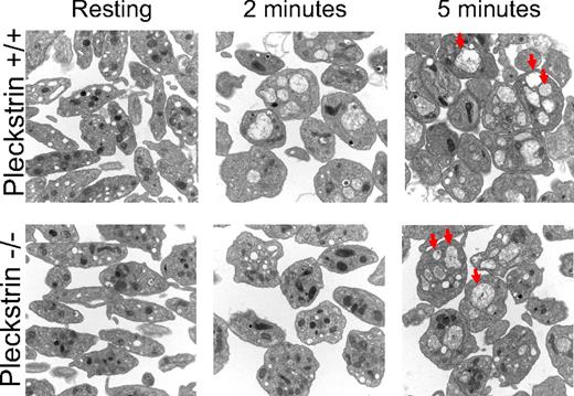 Figure 5. Loss of pleckstrin allows granule-to-granule fusion. Morphologies of platelet granules were analyzed in resting platelets and in platelets exposed to PMA for 2 or 5 minutes. Platelets derived from wild-type or pleckstrin-null platelets appeared identical under basal conditions. Wild-type platelets coalesced their granules more rapidly than platelets lacking pleckstrin (compare images in middle column.) However, wild-type and pleckstrin-null platelets appeared identical after 5 minutes of stimulation, with both genotypes of platelets having numerous merged granules (several examples indicated by arrowheads.) This shows that loss of pleckstrin impairs the efficiency of granule-to-granule fusion but does not prevent it. Shown are 20 000× magnifications captured with an FEI Tecnai T12 electron microscope operated at 80-kV accelerating voltage.
