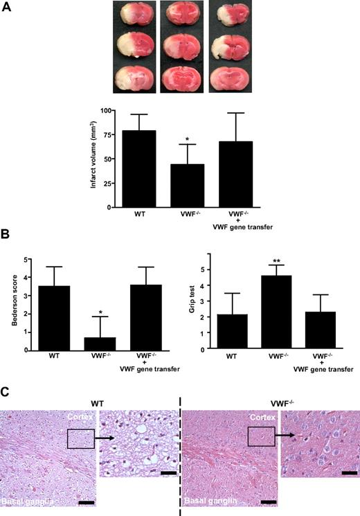 Figure 1. Infarct volumes and functional outcomes 24 hours after transient middle cerebral artery occlusion in WT mice, VWF−/− mice, and VWF−/− mice after reconstitution with plasma VWF (gene transfer). (A top) Representative 2,3,5-TTC stains of 3 corresponding coronal brain sections of the 3 groups at day 1 after transient middle cerebral artery occlusion (tMCAO). (Bottom) Brain infarct volumes of the 3 groups as measured by planimetry at day 1 after tMCAO (n = 10 per group). (B) Neurologic Bederson score (left) and grip test score (right) of the 3 groups as assessed at day 1 after tMCAO (n = 10 per group). (C) Hematoxylin and eosin (H&E)–stained sections of corresponding territories in the ischemic hemispheres of wild-type (WT) and von Willebrand factor (VWF)−/− mice. Infarcts are restricted to the basal ganglia in VWF−/− mice but consistently include the neocortex in WT controls. Bar represents 100 μm or 20 μm (enlarged picture), **P < .01, *P < .05; unpaired 2-tailed Student t test compared with WT mice.