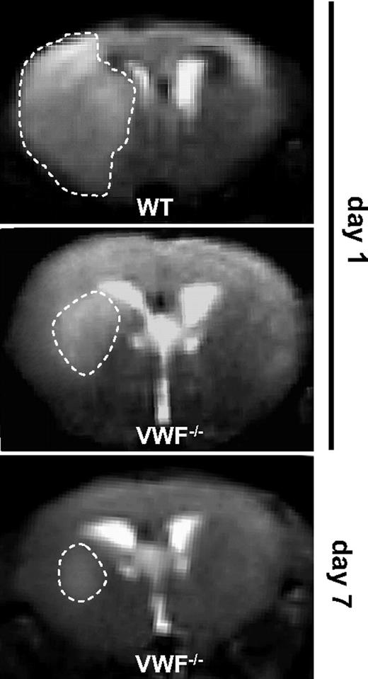 Figure 2. Serial magnetic resonance (MR) images of cerebral infarcts after tMCAO in WT and VWF−/− mice. Serial coronal T2-weighted gradient echo MR sequences show hyperintense (bright) ischemic lesions (white dashed lines) at day 1 after tMCAO in WT mice (top) and VWF−/− mice (middle). Infarcts at day 1 are smaller in VWF−/− mice than in WT mice and remain restricted to the basal ganglia at day 7 (bottom) excluding delayed infarct growth. Hypointense (dark) areas indicative of intracerebral hemorrhage were always absent during the infarct course in both VWF−/− mice (middle and bottom) and WT controls (top; n = 8 per group).