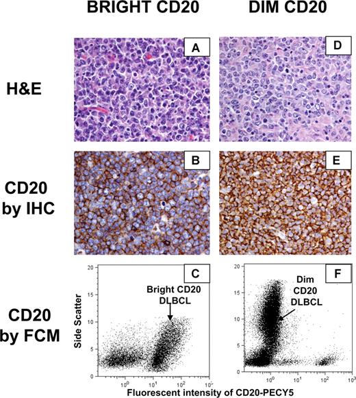 Figure 2. CD20 expression by IHC and FCM of representative “dim” CD20 and “bright” CD20 DLBCL samples. (A) Representative hematoxylin and eosin stain of a “bright” CD20 DLBCL. (B) CD20 protein expression by IHC of a “bright” CD20 DLBCL. (C) CD20 expression by flow cytometry of a “bright” CD20 DLBCL. (D) Representative hematoxylin and eosin stain of a “dim” CD20 DLBCL. (E) CD20 protein expression by IHC of a “dim” CD20 DLBCL. (F) CD20 expression by flow cytometry of a “dim” CD20 DLBCL. (A,B,D,E) Slides were viewed with a Nikon Eclipse E600 microscope (Nikon Canada, Mississauga, ON) at a magnification of 400×. Images were acquired using a Nikon Digital Camera DXM1200 (Nikon Canada) and were processed with Adobe Photoshop version 7.0 software (Adobe Systems, San Jose, CA).
