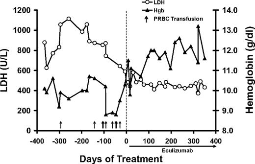 Figure 1. Effect of eculizumab in a patient with cold agglutinin disease. Levels of hemolysis (as measured by LDH, ○) and anemia (hemoglobin, ▲) were documented in the year before and after initiation of eculizumab treatment. Transfusion episodes (↑) are also shown.