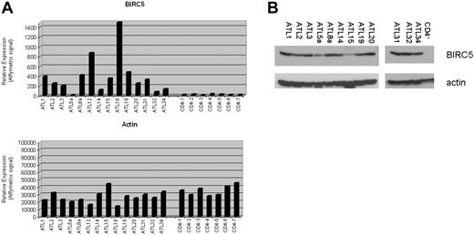 Figure 3. BIRCS expression in ATL patient samples. (A) The relative level of BIRC5 (top panel) and actin (bottom panel) expression obtained from the U133A2.0 arrays was graphed for the indicated ATL or control (CD4+) samples. (B) BIRC5 protein expression was analyzed in ATL or CD4+ whole-cell extracts by Western blot with antibodies to BIRC5 (top panel) or actin (bottom panel).