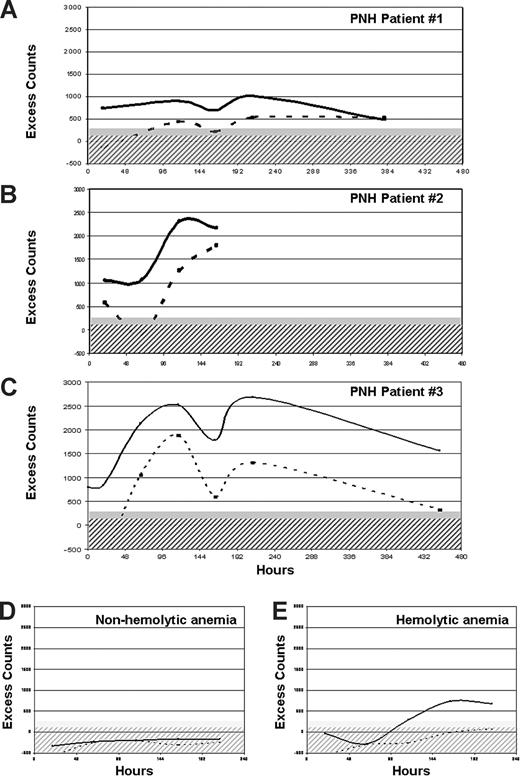 Figure 4. Results of in vivo RBC survival study. (A-C) Three PNH patients (UPNs 1, 2, and 3 in Table 1) with suboptimal response to eculizumab studied by 51Cr RBC labeling. Excess counts on spleen (continuous line) and liver (dashed line) are plotted after correction for background, radioactive decay, and blood radioactivity (ie, heart counts), in function of time. Hatched and filled gray areas represent normal range for liver and spleen excess counts, respectively. Increased entrapment of RBCs in spleen and liver was observed in all the 3 PNH patients. (D) A representative example of a patient with a hyporegenerative (nonhemolytic) anemia, showing no liver or spleen excess count (RBC half-life, 35 days). (E) A representative example of a patient with hemolytic anemia due to extravascular hemolysis, showing liver and especially spleen excess counts (RBC half-life, 8 days).