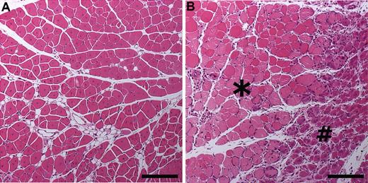 Figure 4. Morphologic characteristics in musculus caput gastrocnemius 7 days after hindlimb ischemia operation. Images were taken from HE-stained 5-μm paraffin sections of mouse tissues and analyzed with Olympus Provis AX70 Microscope attached to Olympus ColorView 12 Camera. The software for imaging and analyses was AnalySIS (Soft Imaging System). (A) Increased regeneration shown in a hVEGF-D TG mouse on day 7 after hindlimb ischemia operation. Whole area showed late regeneration features as eosinophilic cytoplasm and internalization of nuclei. Bar, 200 μm. (B) Control group showed large area of necrosis with pale flocculated cytoplasm (*). Early stage of regeneration is represented by basophilic small myocytes with internalized nuclei (#). Bar, 200 μm.