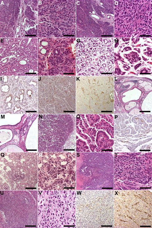 Figure 6. Representative histology of tumors in hVEGF-D TG mice. Images were taken from HE-stained or immunohistochemically stained paraffin sections of mouse tissues and analyzed with Olympus Provis AX70 Microscope attached to Olympus ColorView 12 Camera. The software for imaging and analyses was AnalySIS (Soft Imaging System). (A) Mammary adenocarcinoma with a predominantly solid growth pattern showed focal ducts. Bar, 200 μm. The objective lens used was UPlanApo 4×/0.16 ∞/− (Olympus). (B) Higher magnification of the solid part of mammary carcinoma shown in panel A with atypical cells and a few mitotic figures. Bar, 50 μm. The objective lens used was UPlanApo 20×/0.70 (Olympus). (C) Mammary adenocarcinoma with a solid growth pattern displaying only single remnants of ducts. Bar, 200 μm. The objective lens used was UPlanApo 4×/0.16 ∞/− (Olympus). (D) Higher magnification of the solid part of mammary carcinoma shown in panel C with atypical cells and a few mitotic figures. Bar, 50 μm. The objective lens used was UPlanApo 20×/0.70 (Olympus). (E) Mammary adenocarcinoma showing a tubular growth pattern. Bar. 200 μm. The objective lens used was UPlanApo 4×/0.16 ∞/− (Olympus). (F) Higher magnification of the carcinoma shown in panel E showing both tubular and solid areas. Bar, 50 μm. The objective lens used was UPlanApo 20×/0.70 (Olympus). (G) Well-differentiated mammary adenocarcinoma showing a tubular growth pattern. Bar, 200 μm. The objective lens used was UPlanApo 4×/0.16 ∞/− (Olympus). (H) Higher magnification of the carcinoma shown in panel G. Bar, 50 μm. (I) Immunostaining for hVEGF-D was positive in the surface of ductular structures. Picture from carcinoma is shown in panels E and F. Bar, 100 μm. The objective lens used was UPlanApo 10×/0.4 Ph1 ∞/0.17 (Olympus). (J) Solid parts of tumor shown in panels E and F showed CK7 immunopositivity. Bar, 200 μm. The objective lens used was UPlanApo 4×/0.16 ∞/− (Olympus). (K) Increased number of vessels with angiogenic features in mammary adenocarcinoma shown in panels C and D. Bar, 200 μm. The objective lens used was UPlanApo 4×/0.16 ∞/− (Olympus). (L) Lung with metastases of mammary adenocarcinoma. Original tumor shown in panels E and F. Bar, 50 μm. The objective lens used was UPlanApo 20×/0.70 (Olympus). (M) Higher magnification of the lung metastasis shown in panel L. Note dilated ducts. Bar, 200 μm. The objective lens used was UPlanApo 4×/0.16 ∞/− (Olympus). (N) Lung papillary adenocarcinoma. Bar, 50 μm. (O) Higher magnification of the adenocarcinoma papillae in tumor shown in panel N. Bar, 50 μm. The objective lens used was UPlanApo 20×/0.70 (Olympus). (P) Positive immunostaining for hVEGF-D in papilla stalk. Note positivity also in vessels at the border of the tumor. Bar, 100 μm. The objective lens used was UPlanApo 10×/0.4 Ph1 ∞/0.17 (Olympus). (Q) Multifocal foci of bronchioloalveolar proliferation in lung adenocarcinoma. Bar, 200 μm. The objective lens used was UPlanApo 4×/0.16 ∞/− (Olympus). (R) Higher magnification of the bronchioloalveolar proliferation in adenocarcinoma shown in panel R. Bar, 50 μm. The objective lens used was UPlanApo 20×/0.70 (Olympus). (S) Solid growth in skin basal cell carcinoma. Note necrosis. Bar, 200 μm. The objective lens used was UPlanApo 4×/0.16 ∞/− (Olympus). (T) Higher magnification of the basal cell carcinoma. Note mitosis. Bar, 50 μm. The objective lens used was UPlanApo 20×/0.70 (Olympus). (U) Skin anaplastic carcinoma consists of spindle cells. Bar, 200 μm. The objective lens used was UPlanApo 4×/0.16 ∞/− (Olympus). (V) Higher magnification of the anaplastic carcinoma. Note atypia. Bar, 50 μm. The objective lens used UPlanApo 20×/0.70 (Olympus). (W) Some tumor cells were positive for hVEGF-D immunostaining in an anaplastic carcinoma. Bar, 100 μm. The objective lens used was UPlanApo 10×/0.4 Ph1 ∞/0.17 (Olympus). (X) Increased number of vessels with angiogenic features in an anaplastic carcinoma shown in panels U and V. Bar, 100 μm. The objective lens used was UPlanApo 10×/0.4 Ph1 ∞/0.17 (Olympus).