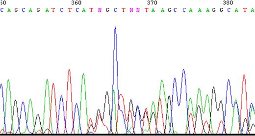 Figure 2. A sample of the tracing of DNA sequencing illustrating the existence of 2 separate sequences obtained with 2 primers. PCR product was produced using primers EX8-up and Ex13-dw and then sequenced. Two nucleotides appear at the same position starting at nucleotide 362, one sequence matching the expected exon 10, whereas the other matches exon 11 ahead of its time.
