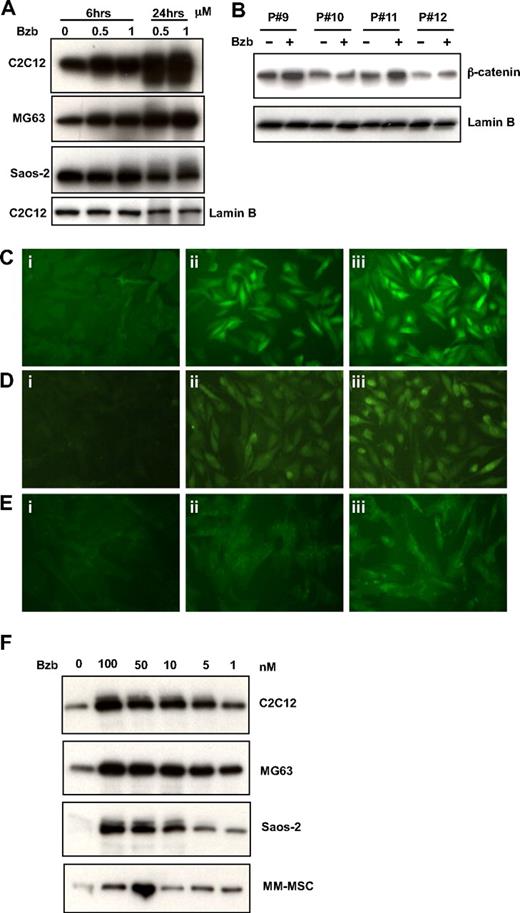 Figure 2. Bzb induces β-catenin accumulation in the nucleus of OBs and MSCs. Nuclear and cytoplasmic fractions of cells of indicated cell lines (A) or msc from myeloma patients (B) described in Figure 1 were separated. Nuclear fractions were lysed and proteins isolated. A total of 5 mg of protein was immunoblotted with β-catenin antibodies followed by membrane stripping and hybridization with an antibody anti-Lamin B to control for protein loading (bottom). Arrows represent ubiquitinated β-catenin. Saos-2 (Ci-Ciii), and MG63 (Di-Diii) cells were treated with 0 (Ci,Di), 50 nM (Cii,Dii), and 100 nM (Ciii,Diii) of Bzb for 12 hours. MSCs from MM patients were cultured in the absence (Ei) or presence of 12.5 (Eii) or 50 nM (Eiii) Bzb for 12 hours. Immunofluorescence microscopy with an antibody specific for β-catenin was used to assess changes in nuclear and cytoplasmic β-catenin. For panels C through E, an Olympus IMT2 inverted research microscope (Olympus, Tokyo, Japan) using an Olympus 40×/0.65 P and a X-CITE 120 illumination systems designed especially for fluorescence microscopy. The fluorescent images were acquired using a SPOT camera (Diagnostic Instruments, Sterling Heights, MI) Model: 2.21 and were processed with an Advanced STOP version 4.7 software (Diagnostic Instruments) and Adobe Photoshop CS2 version 9.02 software (Adobe Systems, San Jose, CA). (F) The indicated cells were treated with indicated concentrations of Bzb for 6 hours. Free β-catenin protein separated using GST-E-cadherin pull down in nuclear lysates was determined by immunoblotting analysis as described in “Immunoblotting.”
