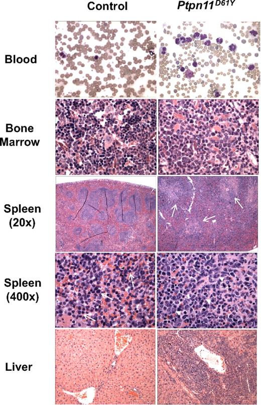 Figure 2. Histopathology of Ptpn11D61Y-evoked MPD. Ptpn11D61Y mice show marked increase of mature myeloid elements in the peripheral blood (×400), bone marrow (×400), and spleen (×20 and ×400), as well as myeloid infiltration in the liver (×100). Myeloid infiltration in the white pulp of Ptpn11D61Y spleen is indicated by arrows (spleen ×20). Whereas control spleens contain mainly immature RBCs (arrows, spleen ×400), mutant spleens show increased myeloid cells (arrowheads, spleen ×400).
