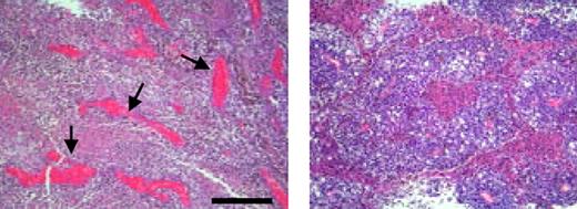The antiangiogenic effects of MSCs injected into melanoma are illustrated by the histologic sections that show blood vessels in an untreated (left panel) and MSC-inoculated (right panel) tumor. There is markedly reduced vascular density in the MSC-treated tumors. Bar equals 300 μm. See the complete figure in the article beginning on page 4197.