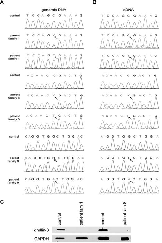Figure 3. Nonsense mutations FERMT3, encoding kindlin-3, result in the LAD1v syndrome. (A) A homozygous c.1525 C>T mutation in exon 12 results in p.Arg509X in patients from the previously described families 1 to 7, and a homozygous c.1717 C>T mutation in exon 14 yields p.Arg573X in family 8. Y and R refer to base position mixtures of C/T and G/A, respectively.(B) Heterozygotes show preferential presence of normal transcripts over mutated FERMT3 transcripts, as shown for families 1 to 7. (C) Irrespective of the mutation, the protein kindlin-3 is undetectable at the expected relative molecular mass of 76 kDa in the platelets of LAD1v patients (and leukocytes, data not shown); the 25-kDa control protein glyceraldehyde-3-phosphate dehydrogenase was observed in all lanes serving as loading control.