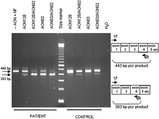 Figure 4. Nucleofection of AONs induces specific exon skipping. RT-PCR analysis of RNA isolated from T cells from an IL-12Rβ1−/− patient and a control 24 hours after nucleofection with various AONs. The primers 1F and 4R are indicated on the right: without exon skipping, a 443-bp product is expected; with exon skipping, a 383-bp product is expected. First lane represents no AON added, with nucleofection; and last lane, water control of the PCR. The size marker is a 100-bp ladder.