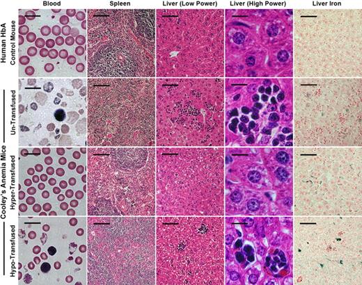 Figure 4. Histopathology of blood, spleen, and liver of humanized HbA control and CA mice before and after transfusion. Peripheral blood smears of untransfused CA mice exhibit severe anemia compared with HbA littermate control mice. There are significant numbers of reticulocytes, circulating erythroblasts, and microcytic, hypochromic, and fragmented RBCs in untransfused CA mouse blood. In addition, the normal structure of red pulp and white pulp in the spleen is absent. In the liver of untransfused CA mice, there are extensive clusters of extramedullary hematopoiesis and increased iron staining. In contrast, the hypertransfused CA mouse has a normal peripheral blood smear and greatly improved histology similar to the HbA control, except excess iron is present in the liver. Hypotransfused CA mice are still anemic, have significant numbers of erythroblasts and thalassemic RBCs in the blood, and have a histopathology similar to the untransfused CA mouse. All mice are 8 weeks of age, except for the untransfused CA mouse, which is only 2 weeks old. Scale bars: blood smear, 10 μm; spleen, 100 μm; liver (low power), 50 μm; liver (high power), 10 μm; liver iron, 50 μm.