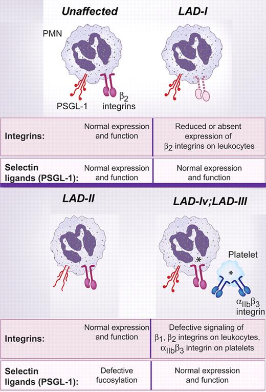 Figure 1. Molecular defects in LAD syndromes. In each syndrome, leukocytes have defects in adhesion and targeting to sites of microbial invasion and tissue injury.1–3,8 Molecular defects in LAD syndromes result in recurrent infections with bacteria and fungal pathogens, inability to form pus at extravascular sites, and other clinical features. LAD-I is caused by mutations in the gene for the β2 subunit of the β2 family of integrins (also termed leukocyte integrins and CD11/CD18 integrins), resulting in decreased or absent levels of these heterodimers on circulating leukocytes. This impairs their ability to rapidly adhere tightly to activated, “inflamed” endothelial cells in response to signaling molecules (PAF, chemokines) displayed on the endothelial surface and to emigrate from vessels at sites of infection or injury. Leukocytes from subjects with LAD-II have intact β2 integrin expression and function but impaired adhesive functions of selectin ligands, chiefly P-selectin glycoprotein ligand 1 (PSGL-1). This defect is caused by mutations in a fucose transporter and consequent defective fucosylation of PSGL-1 and other glycoproteins, and results in impaired tethering and rolling of leukocytes on activated endothelial cells. These are initial events in the multistep process of leukocyte adhesion and emigration.1 In LAD-Iv/III, expression of integrin heterodimers and selectin ligands is normal, but there is defective activation-dependent signaling (inside-out signaling; starbursts in the figure) of β2 integrins resulting in adhesion defects similar to those in LAD-1. There is also defective signaling of αIIbβ3 integrin on platelets, resulting in impaired aggregation and a Glanzmann-like bleeding disorder. In addition, there is evidence for impaired β1 integrin activation on hematopoietic cells in LAD-lv/III. Adapted from Bunting et al.1
