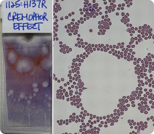 Cremophor (polyoxyethylated castor oil; BASF, Florham Park, NJ) is a nonionic surfactant that is used for solubilization of paclitaxel. Laboratory artifacts such as hyperlipidemia, rouleaux, red cell aggregation, thrombocytosis, and normocytic normochromic anemia can be associated with the use of Cremophor. Cremophor can be detected in plasma 24 hours after infusion, depending on the length of paclitaxel infusion. / A patient received paclitaxel 1 day prior to blood testing. The automated hematology analyzer (CELL-DYN Sapphire; Abbott Diagnostics, Abbott Park, IL) rejected the complete blood count results because of “resistant RBCs.” Accurate results were subsequently obtained using the “resistant RBC” analysis mode. When a blood smear was made, large clear areas developed on the smear (see left image). Microscopic review showed circular gaps between the red cells (see right image) as well as rouleaux formation and red cell aggregates. / Laboratory artifacts associated with Cremophor use should be recognized to avoid unnecessary additional testing or incorrect diagnoses. Misleading surfactant effects can be anticipated when patients have received a hydrophobic drug that is solubilized in nonionic surfactants, such as Cremophor. Some of these hydrophobic drugs include anesthetics, sedatives, immunosuppressives, sensitizers, antineoplastics, and antifungals.