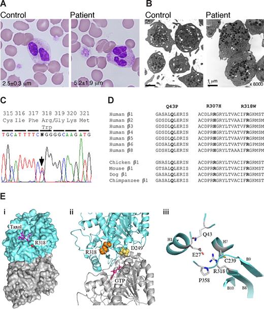 Figure 1. Platelet morphology and the TUBB1 R318W mutation. (A) Peripheral blood smears were stained with May-Grünwald Giemsa for a normal control (TUBB1 43QQ/307RR) and the patient (original magnification ×1000). The patient showed giant platelets with morphologically normal leukocytes. The number in each panel shows the mean platelet size in microns (n = 200). (B) Ultrastructure of platelets. Platelet-rich plasma prepared from acid-citrate-dextrose citrated whole blood was fixed in 2% glutaraldehyde and postfixed in 1% osmium tetroxide. The platelet samples were embedded in epoxy resin (Quetol 651; Nissin EM, Tokyo, Japan). Ultra-thin sections were cut, stained with uranyl acetate and lead citrate, and observed under a transmission electron microscope (JEM 1011, JEOL, Tokyo, Japan) Original magnification ×8000. (C) The entire coding regions of the patient's TUBB1 gene were amplified from genomic DNA by polymerase chain reaction (PCR) and amplified DNA fragments were subjected to direct cycle sequence analysis. A C-to-T transition at nucleotide 952 (952C>T), changing Arg318 to Trp (R318W), was detected. The arrow shows the position of the substitution. (D) β-Tubulin sequence alignment. Amino acid sequence alignment is shown for the 7 human β-tubulin isoforms and the known β1-tubulin from other species. R318 is conserved in other species and other human β-tubulin isoforms. The substituted amino acid is indicated in bold. (E) Structural analysis of R318 using a tubulin 3D model. (i) Position of R318 (red) in the whole tubulin molecule. The residue is almost buried beneath the taxol pocket of β-tubulin but exposed slightly. Blue indicates β-tubulin; gray, α-tubulin. (ii) R318 (orange) is located near the α and β intradimer interface. D249 (yellow) is located at the interface. GTP (magenta) bound on the N-site of α-tubulin is also shown. (iii), Residues surrounding the side chain of R318. All the figures are depicted from 1JFF with the aid of MacPyMol (DeLano Scientific, Palo Alto, CA; http://www.delanoscientific.com/).