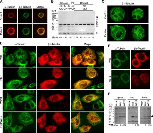 Figure 2. Biochemical analysis of β1-tubulin in platelets and transfected cells. (A) Immunofluorescence analysis of platelets. After being fixed in methanol and permeabilized in acetone, the peripheral blood smears were hydrated with PBS and blocked with normal goat serum. Slides were concomitantly incubated with DM1A and NB2301, and then reacted with Alexa 555-labeled anti–mouse IgG and Alexa 488-labeled anti–rabbit IgG (Invitrogen). The stained cells were examined under a BX50 fluorescence microscope with a 100×/1.35 numeric aperture oil objective (Olympus, Tokyo, Japan). Image slides were taken with a DP70 digital camera using DP Manager software (Olympus). (B) Immunoblot analysis of platelets. Whole platelet proteins were isolated using a NucleoSpin RNA/Protein kit (Macherey-Nagel, Düren, Germany), separated by sodium dodecyl sulfate–polyacrylamide gel electrophoresis on 4% to 12% gradient acrylamide slab gels (Invitrogen), and electroblotted onto polyvinylidine difluoride membranes. The blots were incubated with RB9281 and NB2301, and reacted with horseradish peroxidase-conjugated secondary antibody. The bound antibodies were visualized using an enhanced chemiluminescent substrate. Densitometric analysis of blots performed using ImageQuant software (Molecular Dynamics, Sunnyvale, CA) showed that the β1-tubulin/α-tubulin ratio was reduced by 50% in the patient compared with controls (0.75 vs 1.57 ± 0.11; n = 7). (C) Megakaryocytes derived from the peripheral blood CD34+ cells of a normal control and the patient were doubly stained with anti-GPIIb mouse monoclonal antibody SZ22 (not shown) and NB2301 (green). Although the distribution of β1-tubulin in the patient's megakaryocytes was normal, irregular and large bleb protrusions were observed in the patient. (D) Immunofluorescence analysis of transfected CHO cells. TUBB1-myc transfected CHO cells grown on chamber slides were doubly stained with anti-myc tag antibody and DM1A, and reacted with Alexa 488-labeled anti–rabbit IgG and Alexa 555-labeled anti–mouse IgG. Note that W318 mutants were only localized as small punctuate structures. (E) TUBB1-myc transfected CHO cells grown on chamber slides were exposed to 4°C for 4 hours to facilitate the depolymerization of microtubules, and then fixed and stained. Aggregates of β1-tubulin W318 did not dissociate under conditions of microtubule depolymerization. (F) Low temperature-exposed TUBB1-myc transfected CHO cells were lysed in 10 mM Pipes, pH 6.8, 1 mM MgCl2, 1 mM EGTA, 10% dimethyl sulfoxide, 0.5% Nonidet P-40, and Complete Protease Inhibitor Cocktail (Roche Diagnostics, Mannheim, Germany), and incubated for 30 minutes at 37°C. Cell lysates were centrifuged at 1000g for 10 minutes at 37°C before supernatants and pellets were collected for immunoblot analysis with anti-myc tag antibody. Densitometric analysis of the blots showed that a large proportion of β1-tubulin W318 was recovered in the pellets. The arrowhead indicates recombinant myc-tagged β1-tubulin.