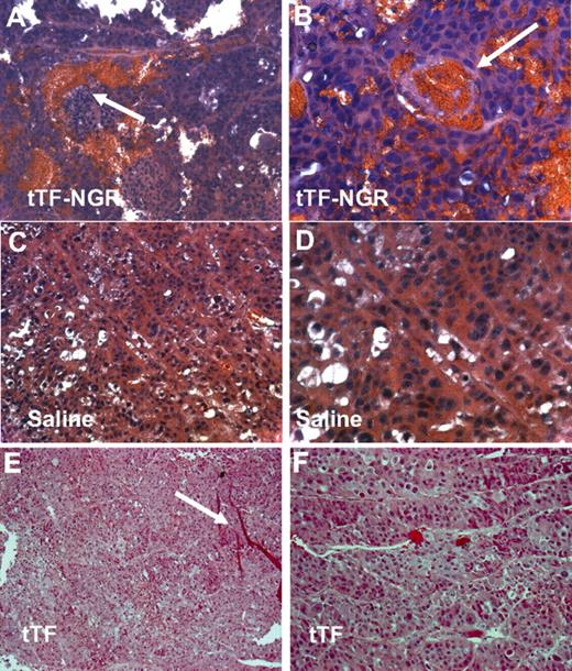 Figure 6. H&E staining of human xenotransplants (M21) in mice. H&E staining of the tTF-NGR–treated tumors showed thrombosis of blood vessels and extensive blood pooling due to vascular disruption (arrows indicating the occluded blood vessels; A,B). The tumors in the saline (C,D) or the tTF (E,F)–treated control group exhibited no thrombosis. Red stripes in panel E are artifacts (arrow). Original magnifications, ×200 (A,C,E) and ×400 (B,D,F).
