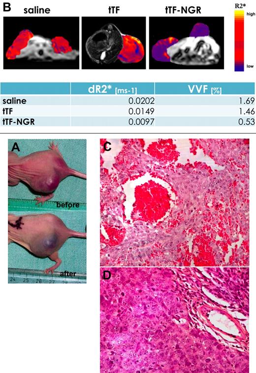 Figure 7. Fibrosarcoma-bearing mouse before and after injection of tTF-NGR. (A) Photograph of a fibrosarcoma-bearing mouse before and after injection of tTF-NGR (1.5 mg/kg body weight). The tumor was blackened after tTF-NGR injection, indicating blood pooling due to vascular disruption. (B) Measurement of the vascular volume fraction (VVF) by contrast enhanced MRI. By measuring the VVF, a significantly reduced blood volume in the tTF-NGR–treated mouse was detected compared with saline controls, whereas non-targeted tTF had only minor effects. The change in the transverse relaxation rate (ΔR2*), as displayed in the color coded overlay, was significantly reduced after treatment with tTF-NGR. (C) H&E staining of the tTF-NGR–treated tumor showed thrombosis in blood vessels, blood pooling, and vascular disruption. (D) The tumor in the saline-treated mouse exhibited no thrombosis.