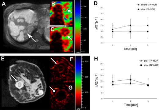 Figure 8. Patient MRIs. Top panel: MRI of a 56-year-old woman with an advanced cholangiocarcinoma. (A) The majority of the liver lesions revealed mainly necrotic and bright at the anatomic T2w image, whereas some smaller vascularized lesions exposed gray (arrow). Parametric, SPIO enhanced ΔR2*-maps of a well vascularized liver lesion (arrow) showed in correlation of pre- (B) to post- (C) tTF-NGR application a clear reduction of the vascular volume fraction (VVF). (D) The corresponding quantitative ΔR2* values revealed after repetitive measurements a 24.9% reduction of the mean tumor blood volume after tTF-NGR application, while the error bars describe the heterogeneous tumor blood volume pattern at the different localizations measured within the whole vascularized liver lesion. Bottom panel: MRI of a 28-year-old woman with lung adenocarcinoma (E). Breast metastasis (arrow) with low vascularization (possibly due to previous bevacizumab) before (F) and after (G) tTF-NGR application showing a reduction of the mean tumor blood volume of 18.2% (H). For details see top panel.