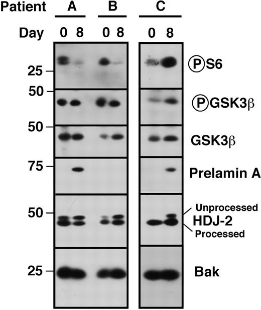Figure 7. Assessment of pathway inhibition in situ. Bone marrow mononuclear cells harvested before institution of therapy (day 0) and on day 8 before drug administration were subjected to immunoblotting with antibodies that recognize phosphor-Ser235/236 ribosomal protein S6, GSK3β phosphorylated by Akt on Ser9 and total GSK3β. The shift in HDJ-2 and appearance of prelamin A on day 8 served to confirm FTase inhibition,9,10 whereas Bak served as a loading control. Note that S6 phosphorylation was inhibited in 2 patients (patients A and B) but not the third (patient C).