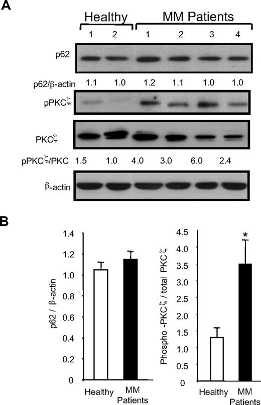 Figure 3. p62, phospho-PKCζ/PKCζ, and VCAM-1 expression in MM stromal cells. Stromal cells (1°) from 13 patients and 11 healthy controls were cultured in 12-well plates for 3 days, and an aliquot of each sample was serum-starved for 12 hours and then exposed to serum for 10 minutes at the end of culture period. Levels of pPKC-ζ were determined in serum-starved samples, while PKCζ, actin, and p62 were determined in the matched unstarved samples by Western blot analysis as described in “Methods.” Equal amounts of protein were loaded in all lanes. (A) Typical results for PKCζ phosphorylation and p62 for 4 MM patients and 2 healthy subjects are shown. The relative levels were compared with healthy patient 2, who expressed the lowest level of p62 and pPKCζ. The black marks reflect splicing of the results to group normal and myeloma subjects together, specifically normal 2 was moved next to normal 1 for the pPKCζ blot. (B) The ratio of p62 and phospho-PKCζ/PKCζ in MM compared with normal stromal cells for 13 MM patients and 11 healthy subjects. Results represent the mean (± SEM). *P < .01.