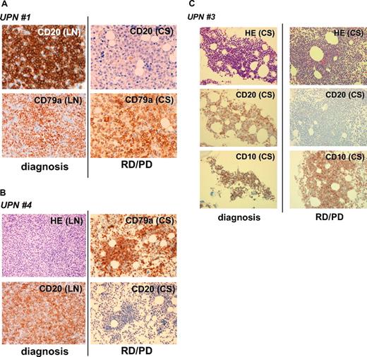 Figure 1. CD20 protein–negative phenotypic changes in CD20-positive B-cell lymphoma patients after treatment with rituximab-containing chemotherapy. Tissue samples (LN, lymph nodes; CS, bone marrow clot section) obtained from UPNs 1 (A), 4 (B), and 3 (C) in Table 2 were analyzed by IHC using anti-CD20, anti-CD79a, and anti-CD10 antibodies. Anti-CD79a antibody was used for detection of B cells. Note that CD20 was positive at the time of initial diagnosis in these patients, and that the CD20-negative phenotypic change was observed during the relapse/progression period. Original magnifications, ×400 (A) and ×200 (B,C) (Olympus BX51TF microscope, Olympus, Tokyo, Japan, and Nikon DS-Fi1 camera, Nikon, Tokyo, Japan). HE indicates hematoxylin and eosin staining; and RD/PD, relapse/progression of disease.