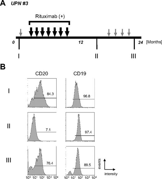 Figure 2. Alteration of CD20 protein expression on B-cell lymphoma cells during disease progression. (A) The clinical course of UPN 3 is depicted briefly. Large black arrows and smaller gray arrows indicate one course of combination chemotherapy with or without rituximab, respectively. Rituximab (375 mg/m2 each) was administered 7 times. During the patient's 24-month clinical course, tumor cells were harvested at stages I, II, and III from lymph nodes, bone marrow, peripheral blood, and/or cerebral fluid. (B) FCM analysis using anti-CD20 and anti-CD19 antibodies was carried out using tumor cells from peripheral blood. Positive cells are shown in the black lines, and the percentage of positive cells is shown. Note that CD20 expression was observed at the initial diagnosis (I, 84.3%), and that the expression then diminished after treatment with chemotherapy with rituximab (II, 7.1%). Interestingly, CD20 protein expression was observed again at the terminal stage after several chemotherapy treatments without rituximab (III, 76.4%). On the other hand, CD19 expression level was stable throughout the clinical course.