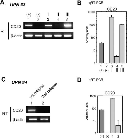 Figure 3. Alteration of CD20 mRNA expression in B-cell lymphoma cells during the clinical course. (A) RT-PCR (RT) was performed using total RNA from the same tumor cells as in Figure 2B (UPN 3 in Table 2). As positive and negative controls, total RNA from Raji and 293T cells was used (lanes 1 and 2), respectively. I, II, and III (lanes 3-5) correspond to the clinical stages depicted in Figure 2A. (B) Quantitative RT-PCR was performed using the same RNA as in panel A. Arbitrary units of CD20 mRNA expression are indicated in the vertical axis. Note that faint expression of CD20 mRNA could be seen at stage II (column 4) despite a loss of CD20 surface protein expression as shown in Figure 2B. (C) CD20 mRNA expression in the lymphoma cells of UPN 4 (Table 2) was also analyzed. Tumor cells were derived from cerebral fluid at the first relapse after chemotherapy without rituximab (lane 1). Although complete remission was obtained after using rituximab-containing salvage chemotherapy, a second relapse occurred. Tumor cells were once again harvested from this patient's cerebral fluid and analyzed (lane 2). (D) Quantitative RT-PCR was also performed using the same RNA as in (C). Note that CD20 mRNA expression was significantly diminished but could still be observed. In these cells, CD20 protein expression was undetectable using FCM or IHC as indicated in Table 2. Positive and negative controls derived from Raji and 293T cells are indicated by + and −, respectively.