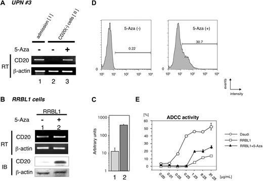 Figure 4. Restoration of CD20 mRNA and protein expression by treatment with the DNA methyltransferase inhibitor 5-Aza. (A) Primary B-cell lymphoma cells, which showed a CD20 protein-negative phenotype from UPN 3, were incubated with or without 5-Aza. Total RNA was prepared, and semiquantitative RT-PCR was performed. Restoration of CD20 mRNA expression after treatment with 5-Aza was observed in lane 3. As a positive control, tumor cells obtained at the initial diagnosis of that same patient were used in lane 1. (B) The CD20 protein-negative B-cell lymphoma cell line RRBL1,32 which was derived from UPN 5 in Table 2, was incubated in culture medium with or without 5-Aza. After preparation of total RNA and whole-cell lysates from these cells, semiquantitative RT-PCR and immunoblotting (IB) were performed. Up-regulation of CD20 mRNA and protein expression was observed as shown in lane 2. (C) Quantitative RT-PCR was performed using the same mRNA as in (B). We observed an up-regulation of more than 10-fold in CD20 mRNA after treatment with 5-Aza (column 2). (D) RRBL1 cells were treated with 5-Aza under the same conditions as in (B), and FCM analysis using anti-CD20 antibody was performed. After treatment with 5-Aza, 30.7% of RRBL1 cells showed a CD20-positive phenotype. Positive cells are shown with black lines, and the percentage of positive cells is also shown. (E) In vitro ADCC analysis using the 51Cr-release assay. Cells from the CD20-positive B-cell lymphoma/leukemia cell lines Daudi and RRBL1 treated with or without 5-Aza were used for this assay. In Daudi cells (○), but not in RRBL1 cells (□), cytotoxic activity was observed in the presence of rituximab in a dose-dependent manner. Partial restoration of rituximab sensitivity in RRBL1 cells was observed after treatment with 5-Aza (▲). Error bars indicate plus or minus 1 standard deviation.