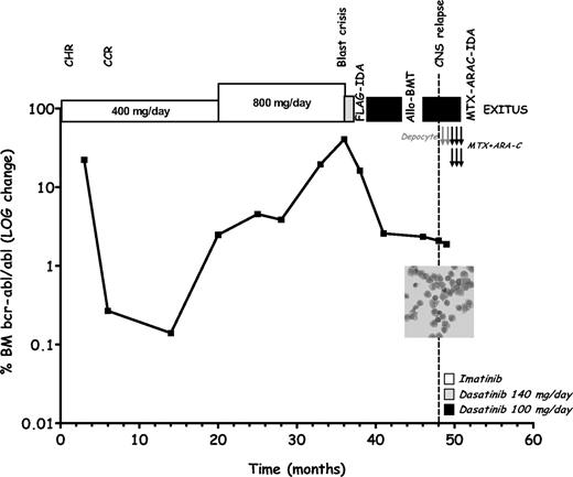 Figure 1. Clinical course of a patient with Philadelphia chromosome–positive chronic myelogenous leukemia developing isolated central nervous system relapse while under dasatinib therapy. At the time of blast crisis, morphologic and flow cytometry studies evidenced 55% of myeloid blasts in the bone marrow (BM) with a CD33+CD13+CD10−CD20−CD45+ immunophenotype (not shown). BCR-ABL levels in BM were quantified by real-time polymerase chain reaction according to a described standard protocol.2 Gray arrow indicates intrathecal therapy with liposomal cytarabine (Depocyte, 50 mg); black arrows indicate intrathecal therapy with methotrexate (MTX, 12 mg) and cytarabine (ARA-C, 50 mg). Inset displays a May-Grünvald-Giemsa–stained cytospin slide of cerebrospinal fluid (CSF) showing myeloid blasts with a CD33+CD13+CD10−CD20−CD45+ at flow cytometry (not shown). At the time of documented leptomeningeal disease, the bone marrow examination was consistent with chronic-phase disease with a blast differential count of 4%. CHR indicates complete hematologic response; CCR, complete cytogenetic response; FLAG-IDA, fludarabine (30 mg/m2 days 1-5), cytarabine (2 g/m2 days 1-5), and idarubicin (10 mg/m2 days 3-5) combination chemotherapy; Allo-BMT, allogeneic bone marrow transplantation; and MTX-ARA-C-IDA, systemic therapy with high-dose methotrexate (3.5 g/m2 day 1) and cytarabine (2 g/m2 days 2-3) plus idarubicin (8 mg/m2 days 2-3).