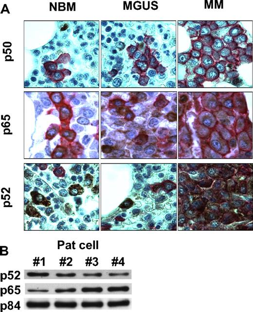 Figure 3. p50 and p52 expression in patient MM cells. (A) Immunohistochemical analysis for p50, p65, and p52 expression was performed on BM tissue microarrays from healthy donors, persons with MGUS, and MM patients. Representative results are shown. CD138 is stained in red; p50 and p52 is stained in brown. Immunohistochemical studies were performed on consecutive serial tissue sections from archival paraffin-embedded bone marrow biopsies from normal individuals (NBM), as well as patients with MGUS and MM. Tissue sections were incubated with either anti-p50, -p65, or -p52 Abs, and immunoreactivity was visualized with peroxidase stains. Histologic micrographs were taken using a Leica DM200 microscope (aperture HC PLANs 10×/22, objective lenses: N PLAN 100×/1.25 oil), and a SPOT Insight QE model camera with SPOT Advanced acquisition software (Diagnostic Instruments, Sterling Heights, MI). (B) Nuclear extracts from patient MM cells were immunoblotted with anti-p52, -p65 Abs. p84 served as a positive control for nuclear protein.