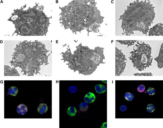 Figure 1. Neutrophils circulating in the blood of patients with acute myocardial infarction contain intracellular platelets. (A-F) Representative images by electron microscopy of neutrophils from 4 patients with acute myocardial infarction. Neutrophils were immediately purified from blood and processed as described in “Adhesion and phagocytosis.” (G-I) Representative confocal microscopy of neutrophils from 3 patients with acute myocardial infarction. Whole blood was processed and stained as described in “Adhesion and phagocytosis.” MPO, green; platelet glycoprotein Ib (CD42), pink. DAPI, blue, was used for counterstaining of nuclei (n = 15).
