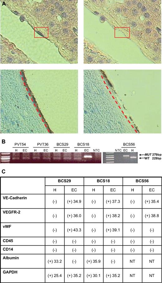 Figure 1. Presence of JAK2V617F in the ECs lining the terminal hepatic venules in the sections of archived liver biopsy tissue specimens from BCS patients. (A) The ECs from a terminal hepatic venule with less congestion from a liver biopsy of a patient with BCS with PV captured by LCM after hematoxylin and eosin staining (top panel) or immunohistochemical staining with an anti-CD34 antibody (bottom panel). These photomicrographs show a portion of a terminal hepatic venule lined by ECs. There is a thin rim of underlying connective tissue in the subendothelial space. The boxed or underlined area shows longitudinally sectioned endothelial cells. The rest of the photo shows plates of hepatocytes arranged in trabeculae. The right panel demonstrates the same areas after laser capture of the ECs. The remaining adjacent tissue remains intact (original magnification ×400; ArcturusXT System (MDS Analytical Technologies). (B) JAK2V617F status of LCM captured hepatocytes (H) and endothelial cells (EC) of patients by allele-specific nested PCR for JAK2V617F. (C) Table summarizing the transcripts present in hepatocytes (H) and ECs isolated by LCM from archived liver biopsy tissue specimens. The numbers represent the average CT values of the samples, which were run in duplicate and repeated on 3 separate occasions.