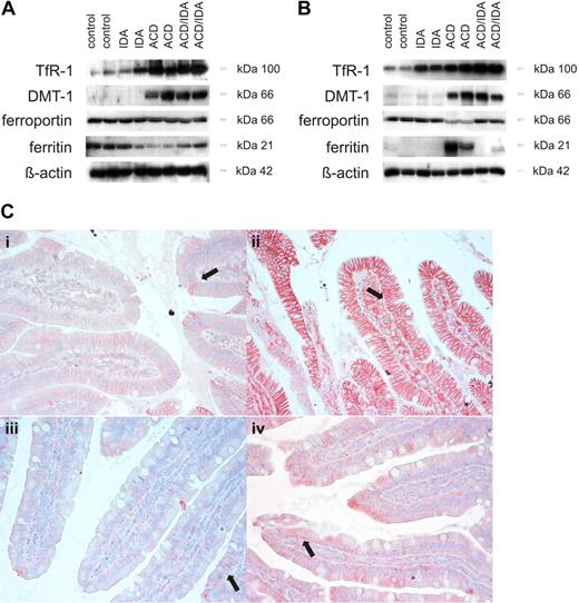 Figure 2. Protein expression of iron metabolism genes in liver, spleen, and duodenum of anemic rats. Rats were injected with PG-APS injection and/or phlebotomized as detailed in “Animals.” Protein extracts from liver (A) and spleen (B) were prepared from nitrogen snap-frozen tissue obtained from control, bleeded (IDA), ACD, and ACD/IDA rats and run on a 10% to 15% sodium dodecyl sulfate–polyacrylamide gel as detailed in “Western blotting.” One of 4 representative experiments is shown. Bright-field photographs of rat duodenum immunohistochemistry (C) were taken from control (i), phlebotomized (IDA; ii), ACD (iii), and ACD/IDA (iv) rats using affinity-purified antiferroportin antibody. ↑ indicates the basolateral ferroportin expression. The images were captured by a Olympus microscope BX51 (Olympus Plan FL20 × /0.75; Olympus, Hamburg, Germany) using a ProgResC12 plus camera (Jenoptik, Jena, Germany) and ProgResCapturePro2.5 software. One of 4 representative slides is shown.