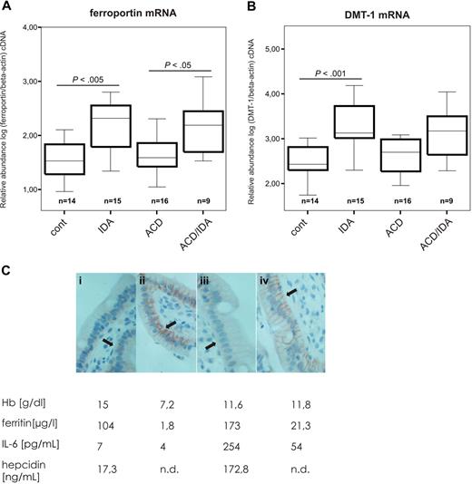 Figure 7. Expression profiles of iron transporter in human duodenal biopsies from control, IDA, ACD, and ACD/IDA patients. Duodenal biopsies were snap-frozen in liquid nitrogen and RNA was prepared, followed by reverse transcription and quantitative TaqMan PCR for ferroportin (A) and DMT-1 (B) mRNA expression. Values were normalized to the mRNA expression levels of the housekeeping gene β-actin. (C) Duodenal biopsies of control (i), IDA (ii), ACD (iii), and ACD/IDA (iv) patients were subjected to immunohistochemistry using an affinity-purified antiferroportin antibody. A representative slide for each parameter measured is shown. ↑ indicates the basolateral ferroportin expression. The images were captured by an Olympus BX51 microscope (Plan FL40× /0.75; Olympus) using a ProgResC12 plus camera (Jenoptik) and ProgResCapturePro2.5 software. In addition, the corresponding hemoglobin, serum IL-6, serum ferritin concentrations, and serum hepcidin levels are shown. n.d. indicates not detectable. Figure 1 contains details on graphs and statistics.